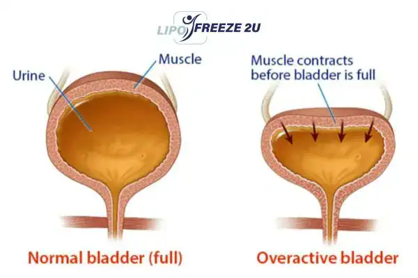 diagram of overactive bladder treatment Manchester