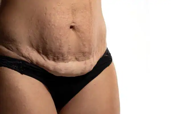 loose skin after weight loss injections Manchester