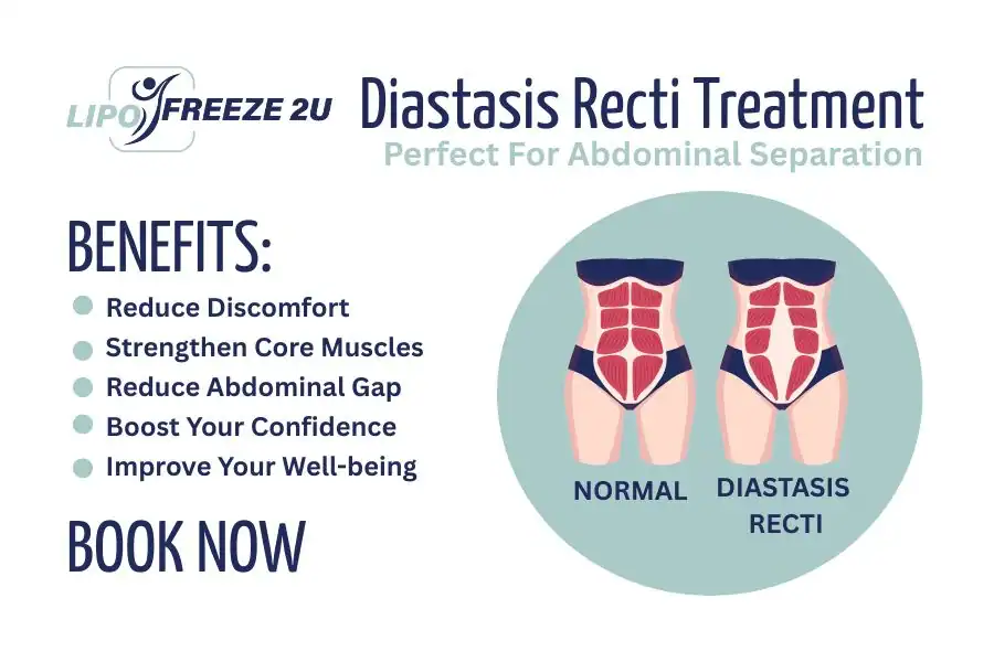 Benefits of body toning treatment Manchester for Diastasis recti