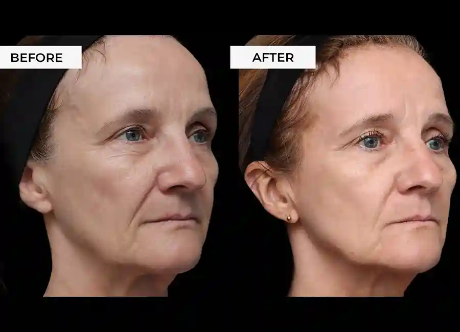 How Many RF Microneedling Sessions Will You Need to See a Difference Manchester?